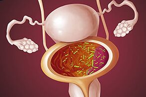 Bir kadında bakteriyel sistit